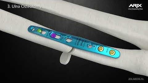 [ARIX OS] ARIX Ulna Osteotomy System