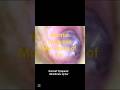 # normal tympanic membrane of ear