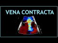 Vena contracta echocardiography