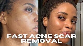 PICO laser for Hyperpigmentation | Dark Skin | Acne Scars | The Simple Farmacist