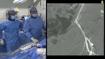 CTO of Common Iliac, Common Femoral, External Iliac via Radial and Femoral Approach - September 2022