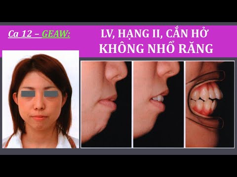 Video: Twinblock: kích thước, mô tả, thông số kỹ thuật, ưu nhược điểm, đánh giá