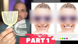 Porcelain Veneers Procedure | Digital Design App to Visualize Smile Makeover! screenshot 2