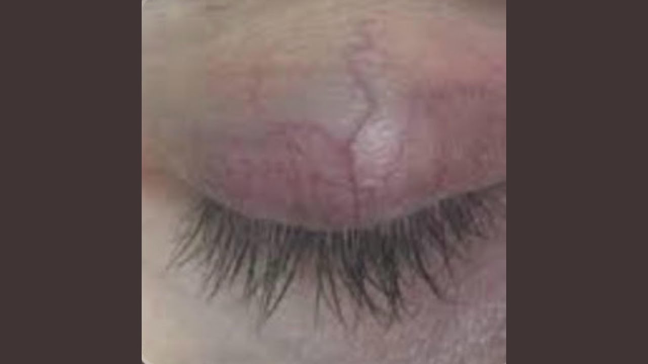 Watch Eyelids on YouTube Watch Eyelids on YouTube