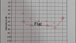 AUDIOGRAM PATTERN AND PROGNOSIS IN SSHL