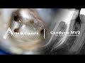 ►Conducto MV2 | Endodoncia | Arte y Ciencia Odontológica