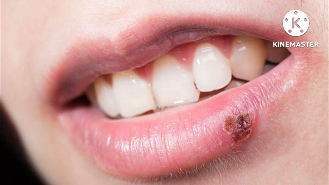 experts-say-more-than-80-percent-population-of-world-has-dormant-herpes