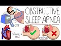 Understanding Obstructive Sleep Apnea Syndrome