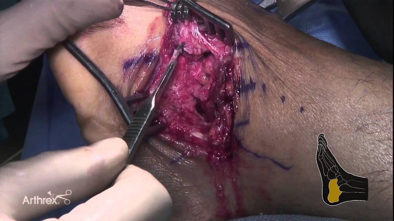 orthopedic banawe Triple Arthrodesis for Cavus Foot