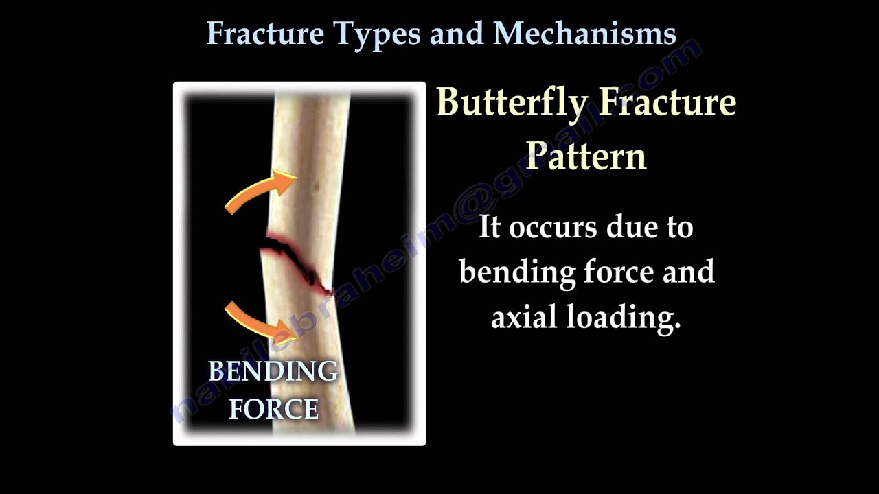 Fractures, Types And Mechanisms Everything You Need To Know Dr