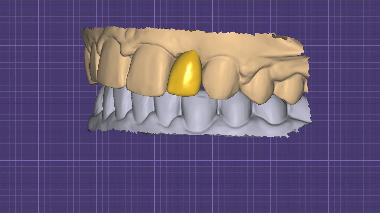 CADCAM designing for upper lateral tooth - YouTube
