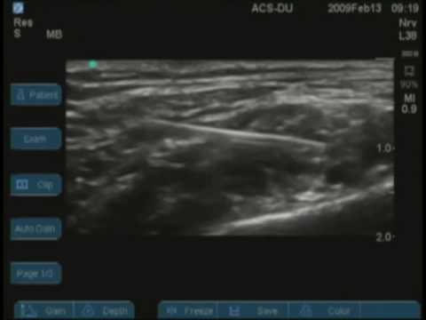 Ultrasound Guided Supraclavicular Nerve Block - YouTube