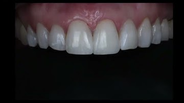 Black Triangle Closure using Bioclear Matrix