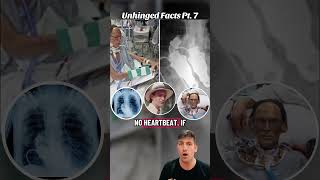 PROOF you don’t need a heart to live! UnhingedFacts Pt7 #history #crazyfacts #recovery #heartbroken