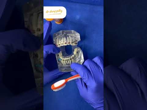 فرشة التقويم و تنظيف التقويم تقويم الاسنان أسنان