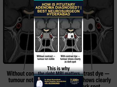 How Is a Pituitary Adenoma Diagnosed? - Best Pituitary Surgeon in Hyderabad | తెలుగు