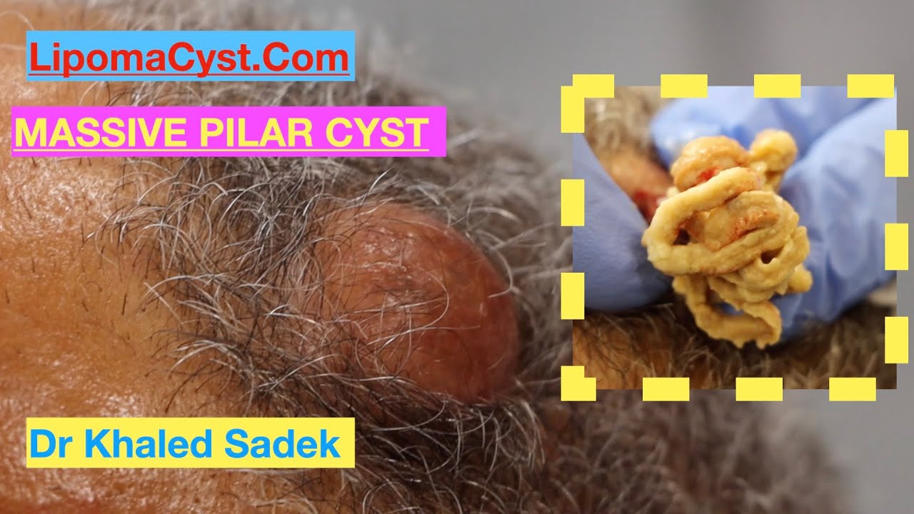 Massive Pilar Cyst. Dr Khaled Sadek LipomaCyst.com