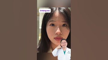 1 chiếc mũi xinh có thể thay đổi cả khuôn mặt  #drkang #drtranbaokhanh