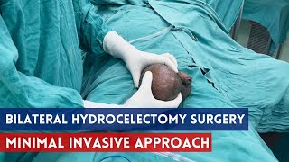 Bilateral Hydrocele Surgery- Both Side | General Surgeon in India | Hydrocele Surgery In Delhi NCR