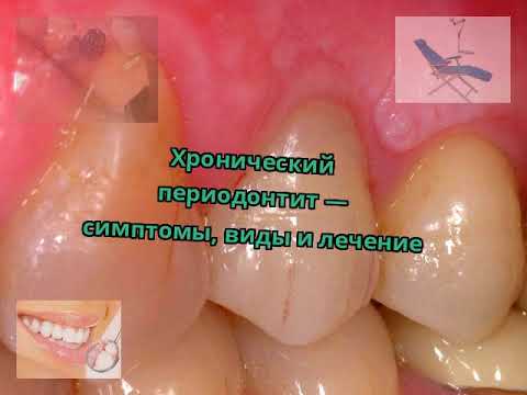 Хронический периодонтит — симптомы, виды и лечение
