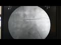 Transforaminal endoscopic discecectomy - fluoroscopy pics