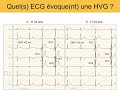 Hypertrophie ventriculaire gauche  quiz ecg dr taboulet