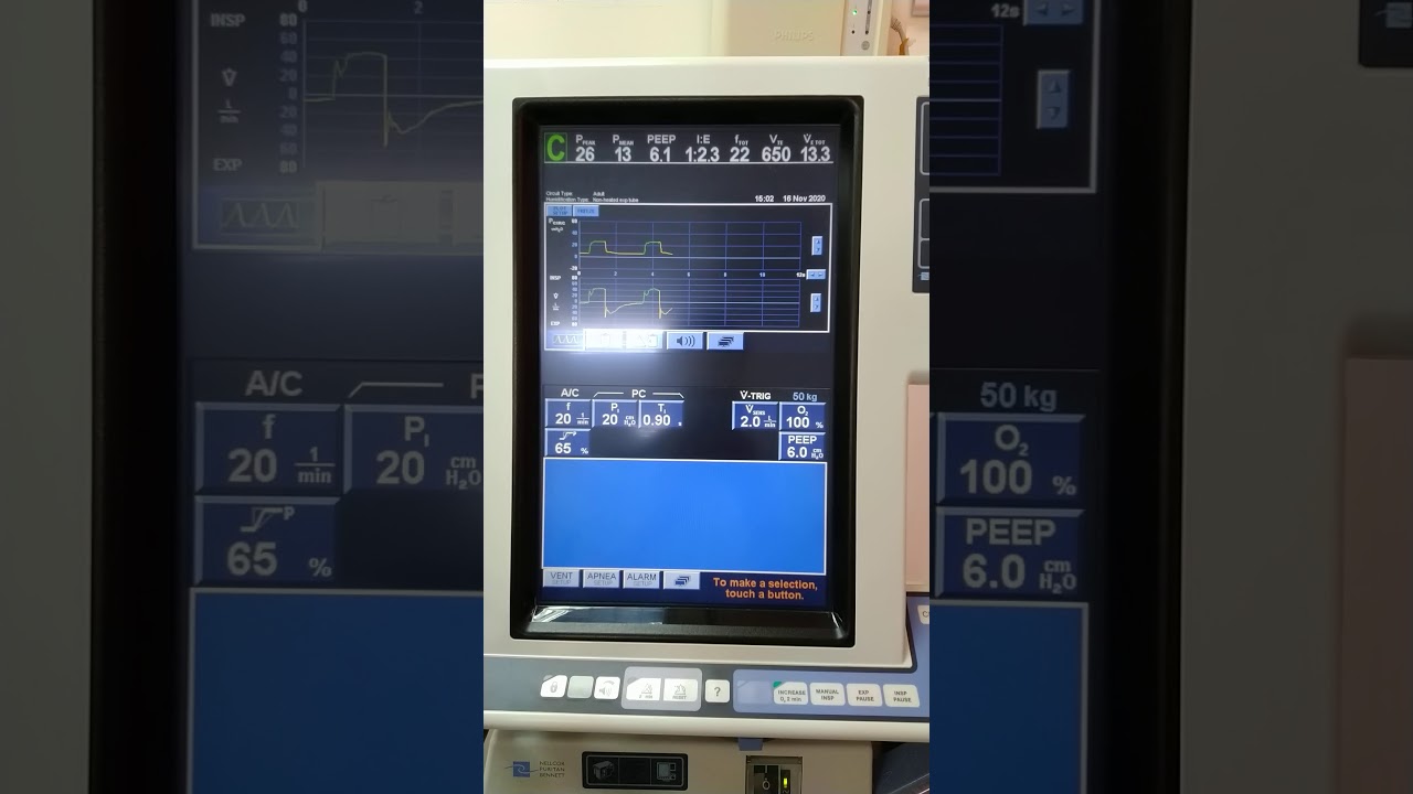 Fentanylinduced chest wall rigidity After Naloxone YouTube