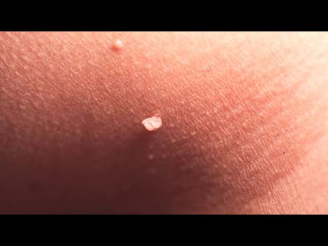 are skin tags bad are skin tags bad