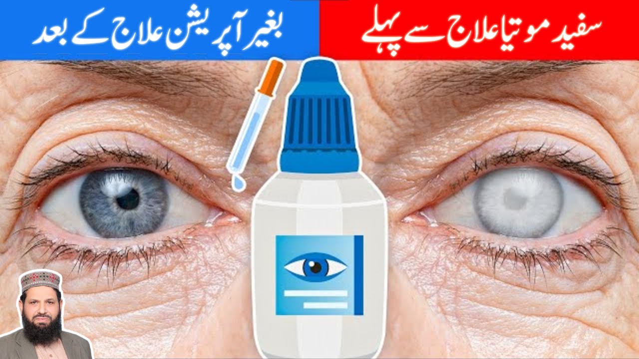 Cataract Cure Without Surgery And cataract-cure-without-surgery-and