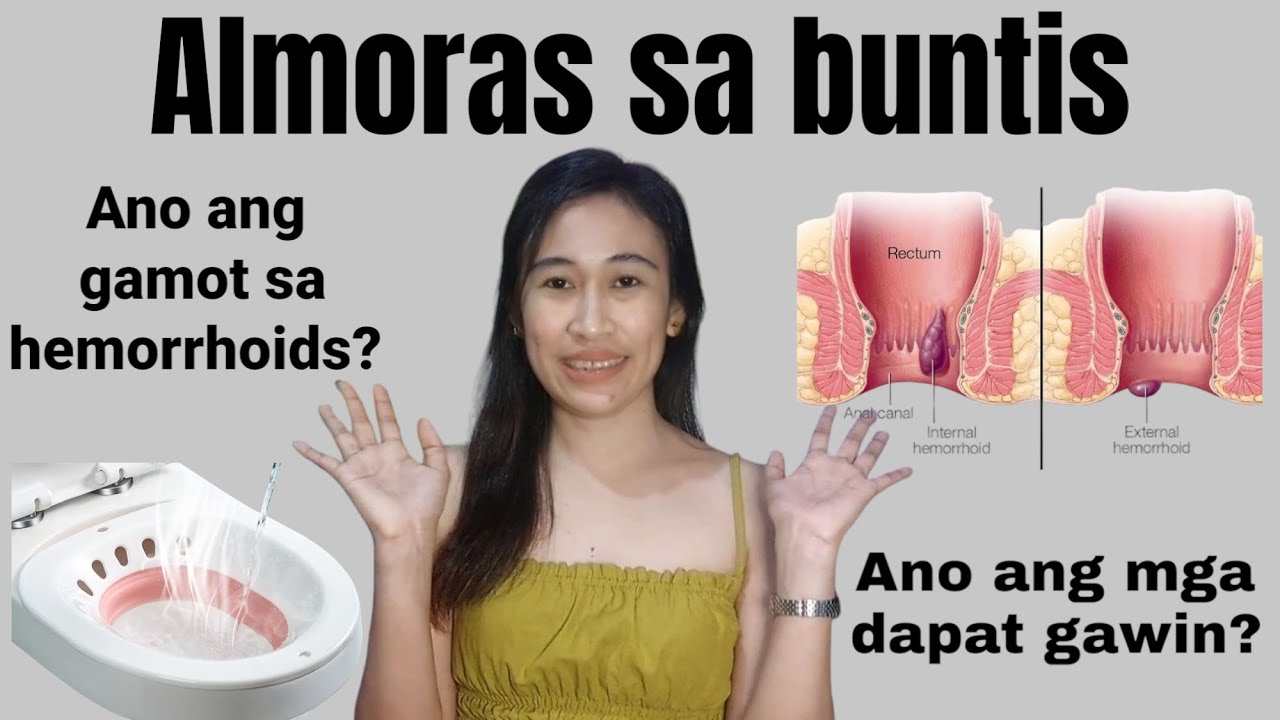 Gamot sa almoranas sa buntis | Tips at gamot sa hemorrhoids