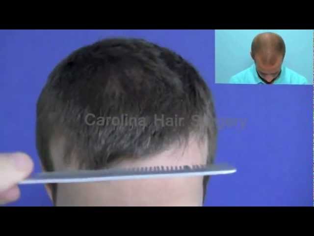 FUE Hair Transplant Before & After | Carolina Hair Surgery