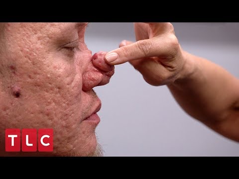 Genner has flown all the way from philippines to have dr. lee help with his bumpy nose. stream full episodes of pimple popper: https://www.tlc.com/tv...