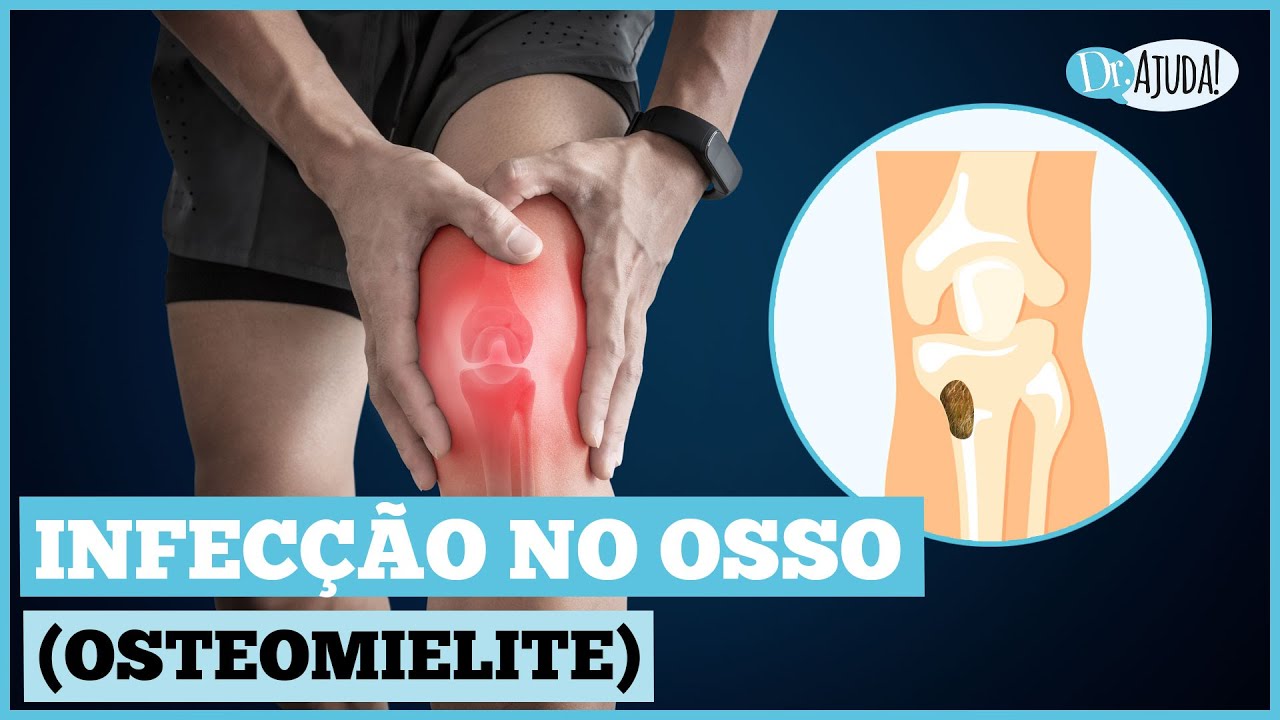 INFECÇÃO NO OSSO (OSTEOMIELITE): QUAIS OS SINTOMAS? O QUE FAZER? - YouTube