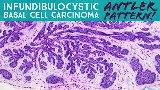 Infundibulocystic Basal Cell Carcinoma (BCC w/ follicular differentiation): Dermpath in 5 Minutes screenshot 5