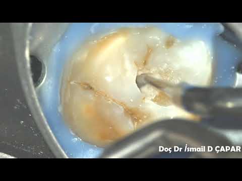 Ninja Acces Cavity on Maxillary Molar /  Üst Büyük Azı Dişinde Minimal İnvaziv Giriş KAvitesi