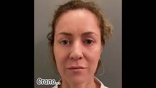 Кантопексия + липофилинг