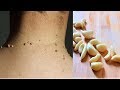 Remove Skin Tags | Home Remedies To Remove Skin Tags Easily