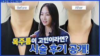 목주름 없애는 방법, 효과 좋은 목주름 시술을 알려드립니다!