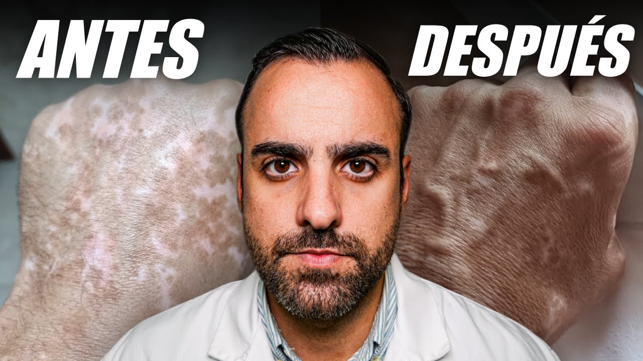 VITÍLIGO en las Manos: causas, SÍNTOMAS y tratamientos