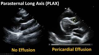 Introduction to Echo: Pathology M3