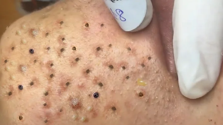 Treat Blackheads on Neck and Chin at Sac Dep Spa