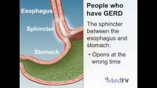 What Happens When You Have GERD?