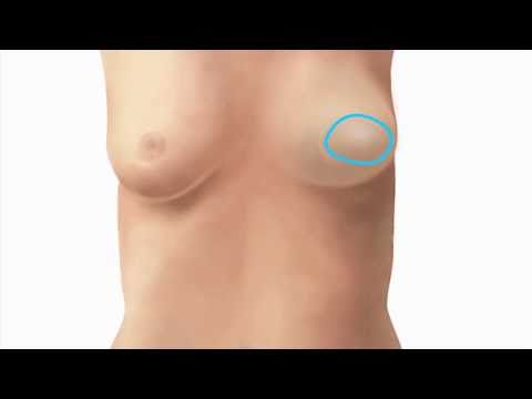 Video: Hvad er grunden til at give et andet setup til at udføre en brystrekonstruktion?