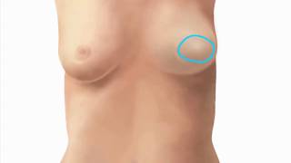 Breast Reconstruction Surgery - DIEP Flap