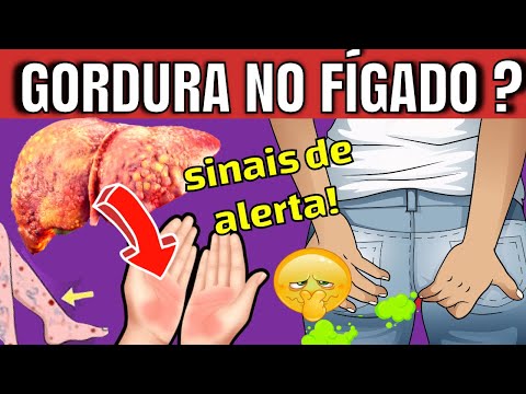 8 SINAIS QUE INDICAM GORDURA NO FÍGADO | SINTOMAS INICIAIS DA ESTEATOSE HEPÁTICA (ameaça silenciosa)