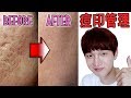 (ENG)【韓國科普向】一定要看..消滅痘印的方法！:Method of deplantIng the pockmark【朴鳴】