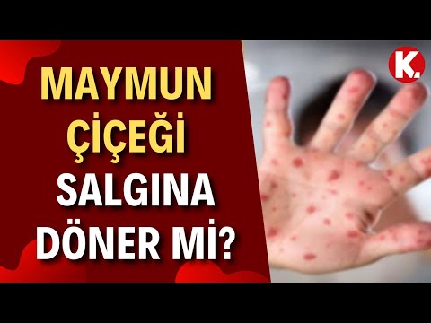 Maymun Çiçeği Hastalığı Türkiye'de Salgına Döner Mi? Prof. Dr. Bülent Ertuğrul Açıklıyor