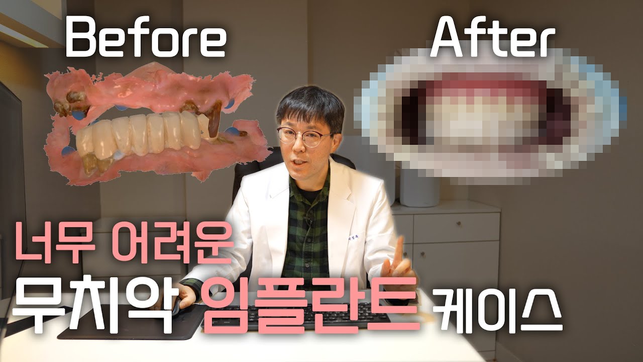 너무 어려운 무치악 임플란트 케이스(임시틀니, 임시치아 만들기)
