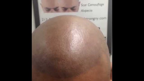 Scalp Micropigmentation NATURAL 3dSMP results in one treatment!