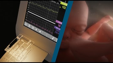 DAWES-REDMAN CTG ANALYSIS® - Een levenswerk